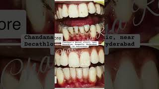 World’s first dental spa Kompally Hyderabad  telugu dentist hyderabad smile smilemakeover [upl. by Nasus]