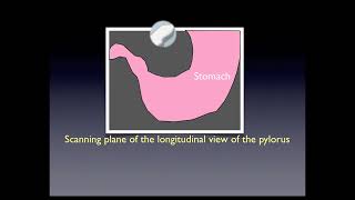 Pyloric Stenosis [upl. by Elocon]