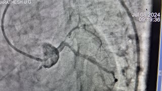 LM LAD stenting ostial LAD 100LAD slowflowsevere LVDcardiogenic shock [upl. by Pip]