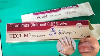 Tecum 003 ointment review। Tacrolimus ointment 003 ww। Leucoderma। Vitiligo। सफ़ेद दाग [upl. by Dnalrag]