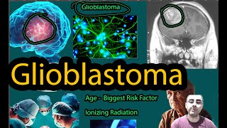 Glioblastoma  Symptoms causes and new hope [upl. by Elleneg]