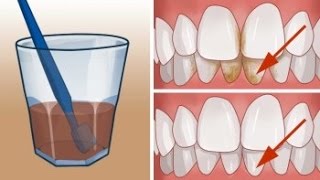 Cómo eliminar el sarro de los dientes naturalmente [upl. by Neeron]