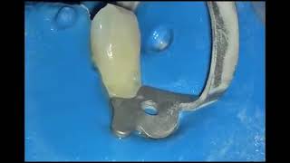 Aquacare 아쿠아케어 Dental Air Abrasion with Aquacut Kinetic Preparation by Grzegorz Witkowski [upl. by Candace]