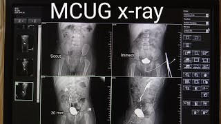 MCUGVCUG xRay procedure micturating cystourethrogram  MCUGVCUG test in Radiology [upl. by Tildi]