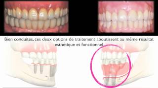 Implants dentairesampEdentement total mandibulaire resorbéImplantsampResorbed edentulous mandible [upl. by Hsreh]