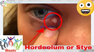 Hordeolum externum OR Stye on Eyelid amp Hordeolum internum with Treatment  EyeOphthalmology [upl. by Anaeerb]