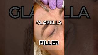 Glabella filler glabellafiller filler botox beforeandafter face nonsurgical antiaging [upl. by Narik746]