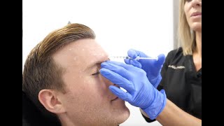 Botox amp Restylane for men Before and After with Dr Andrea Trowers [upl. by Portwine]