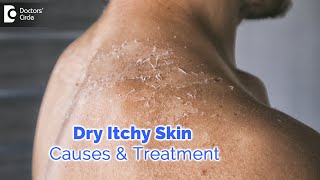 Dry itchy skin all over body Causes Diagnosis Treatment  Dr Rashmi Ravindra  Doctors Circle [upl. by Nyrmac]