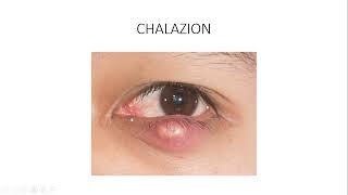 OBENG SERIES  CHALAZION AND HORDEOLUM [upl. by Rumit]