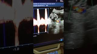 Left uterine artery Doppler [upl. by Ogdon472]