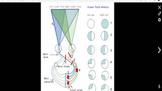 neuroophthalmology 6 a chiasmal disorder [upl. by Flavius]