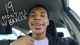 GETTING MY PALATAL EXPANDER REMOVED 19 MONTH ADULT BRACES UPDATE [upl. by Hamal977]