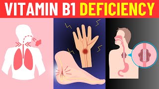 Top 10 Signs and Symptoms of Vitamin B1 Thiamine Deficiency [upl. by Krishna38]