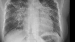 Chest xray Pneumocystis carinii pneumonia lamellar effusion [upl. by Enayr747]