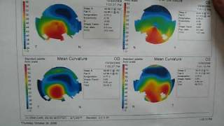 Corneal topography explained [upl. by Suirauqed]