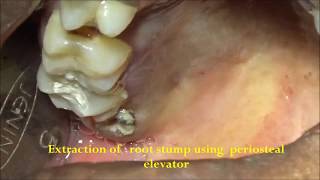 Root stump removal using periosteal elevator [upl. by Samohtnhoj]