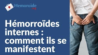 Hemoroide interne  tout comprendre sur les hemorroides internes [upl. by Anma]