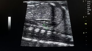 Lying down adrenal sign in bilateral renal agenesis  antenatal ultrasound [upl. by Jackson]