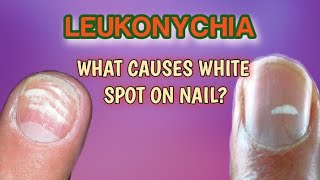 Leukonychia  what are white spot on nail [upl. by Ahsinat]