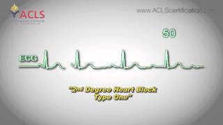 Second Degree Heart Block Type One by ACLS Certification Institute [upl. by Yeleak]