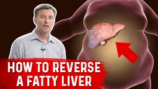 How to Reverse a Fatty Liver  Dr Berg [upl. by Loyce765]