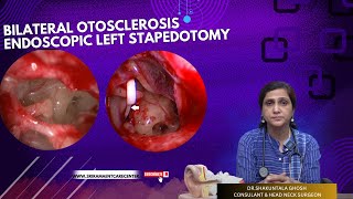 BILATERAL OTOSCLEROSIS ENDOSCOPIC LEFT STAPEDOTOMY  DRSHAKUNTALA GHOSH  SRI RAMA ENT CARE CENTER [upl. by Ynneg]