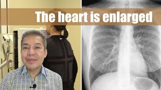 The heart is enlarged sa chest Xray [upl. by Elik82]