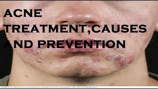 acne treatmentcauses and prevention [upl. by Yaluz963]