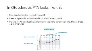 Otosclerosis 4th year [upl. by Osmond]