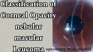 Classification Of Corneal Opacity  Nebular macular Leucoma  Optometry with Shahid [upl. by Ardnik]