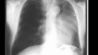 Chest xray  Luftsichel Sign  Left upper lobe collapse [upl. by Yelnahs]