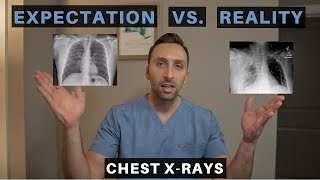 EXPECTATION vs REALITY in RADIOLOGY  How to read a Complicated Chest XRay [upl. by Enirehtak682]