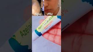 skinoren cream for hyperpigmentation melasma Acne scars pharmacist pharmacy saudiarabia skinoren [upl. by Hollington481]