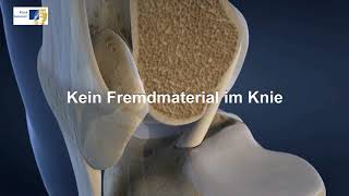 Knie OP bei Kreuzbandriss  3DAnimation Kniegelenk [upl. by Aniwde902]