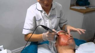 DERMAPEN Skin Needling For Acne Scarring [upl. by Gardie]