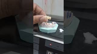 Zirconia bridge 4unit dental shortvideo trendingshorts [upl. by Anceline]