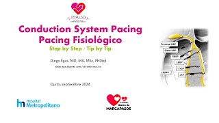 Como hacer Pacing Fisiologico Step by Step para His y Rama izquierda [upl. by Eidlog837]