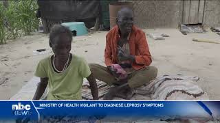 Ministry of Health vigilant to diagnose leprosy symptoms  nbc [upl. by Desimone773]