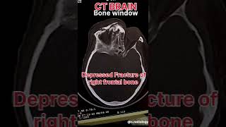 Fracture of frontal bone ct scan radiology [upl. by Calesta]