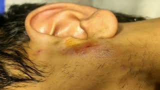 Preauricular abscess drainage without Incision No IncisionDr D K Gupta [upl. by Nauwtna941]