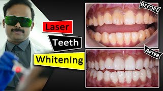 Teeth Whitening With Laser  Fastest amp Safest way [upl. by Alodi]