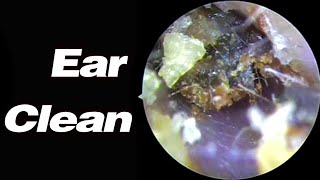 Ear Picking 8 Years Without Cleaning The Earwax Has Become Stones Very Hard To Remove耳掃除ASMR [upl. by Suilenrac]