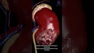 What is Diabetic Nephropathy  Diabetes Microvascular Complications  besugarfit shorts [upl. by Ilak]