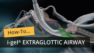 i gel Extraglottic Airway [upl. by Schulz]