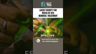 Laser Therapy for Nevus of OTA Removal Treatment  Nevus of OTA Treatment in Delhi  Dr PK Talwar [upl. by Hailed570]