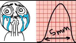 كيف تقيم تخطيط قلب في ألمانيا  المبادئ  EKG Auswertung in Detuschland [upl. by Gilleod]