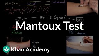 Mantoux test aka PPD or TST  Infectious diseases  NCLEXRN  Khan Academy [upl. by Everest922]