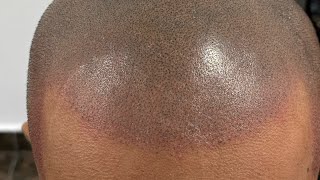 Scalp micro pigmentation in sri lanka [upl. by Schilt543]