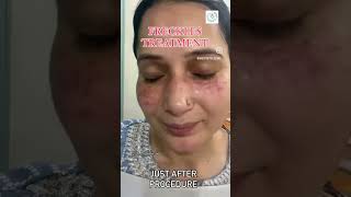 Freckles treatment with laser Single sitting result holi ytshorts delhi holiskincare skincare [upl. by Rabin]